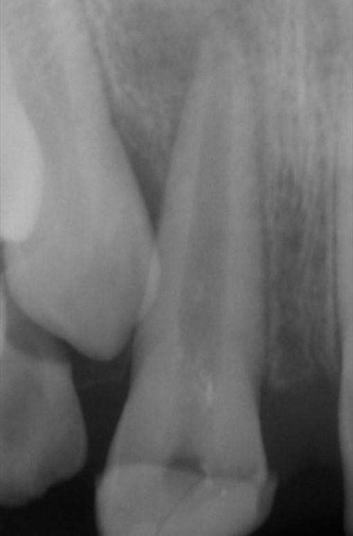 Abb. 3.1: Frontzahn bei einem Kind mit offener Wurzel (Foramen)