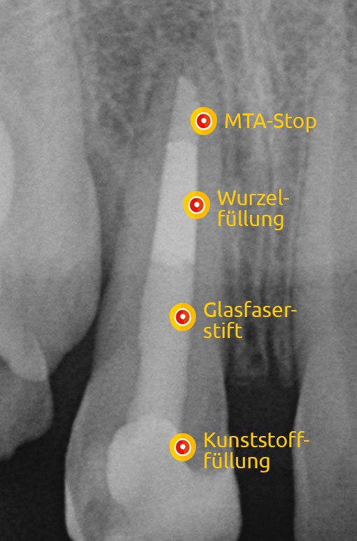 Abb 3.3: MTA-Stop, Wurzelfüllung, Glasfaserstift, Kunststofffüllung